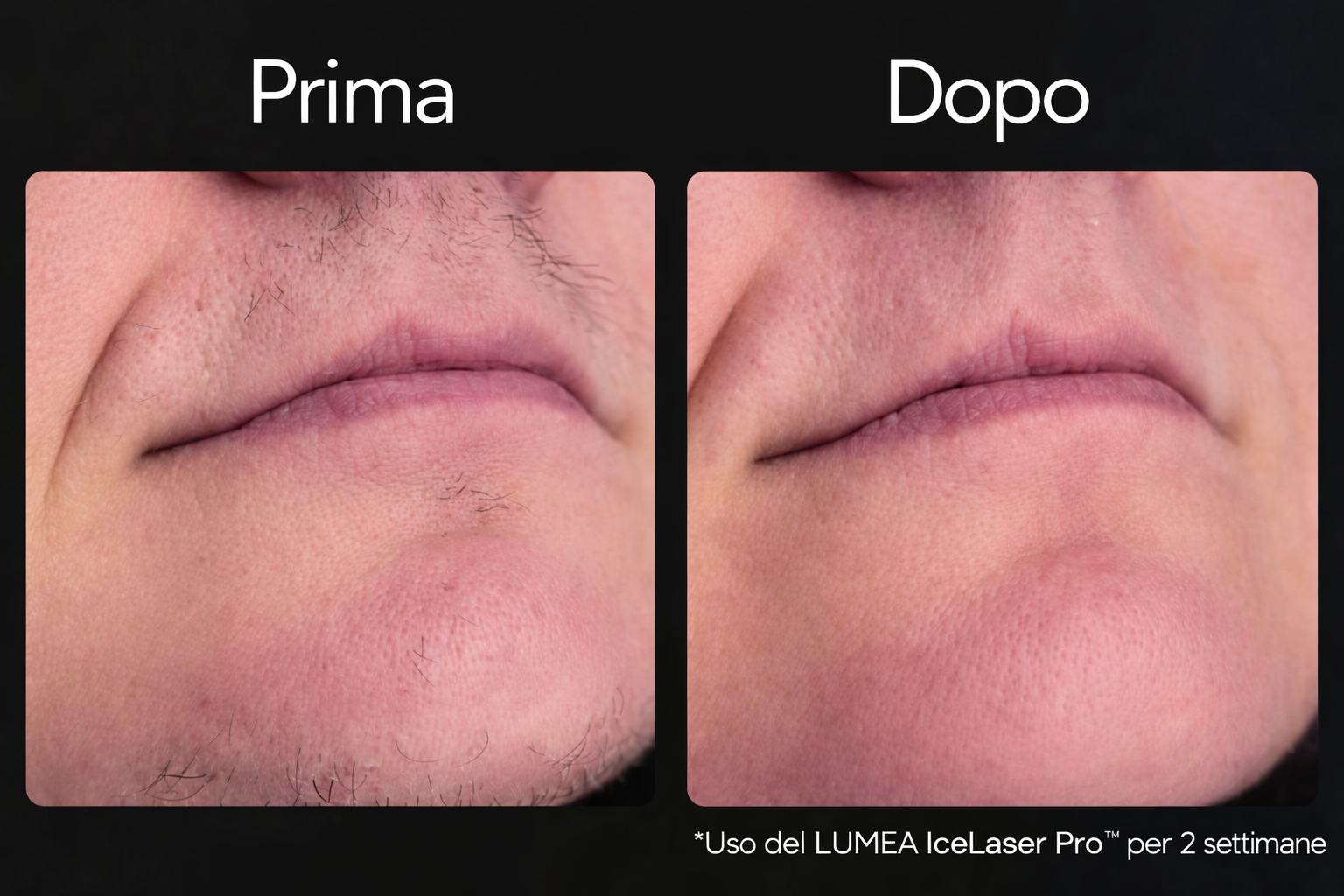 LUMEA IceLaser Pro™: La tecnologia IPL con raffreddamento che lascia la tua pelle liscia come seta.